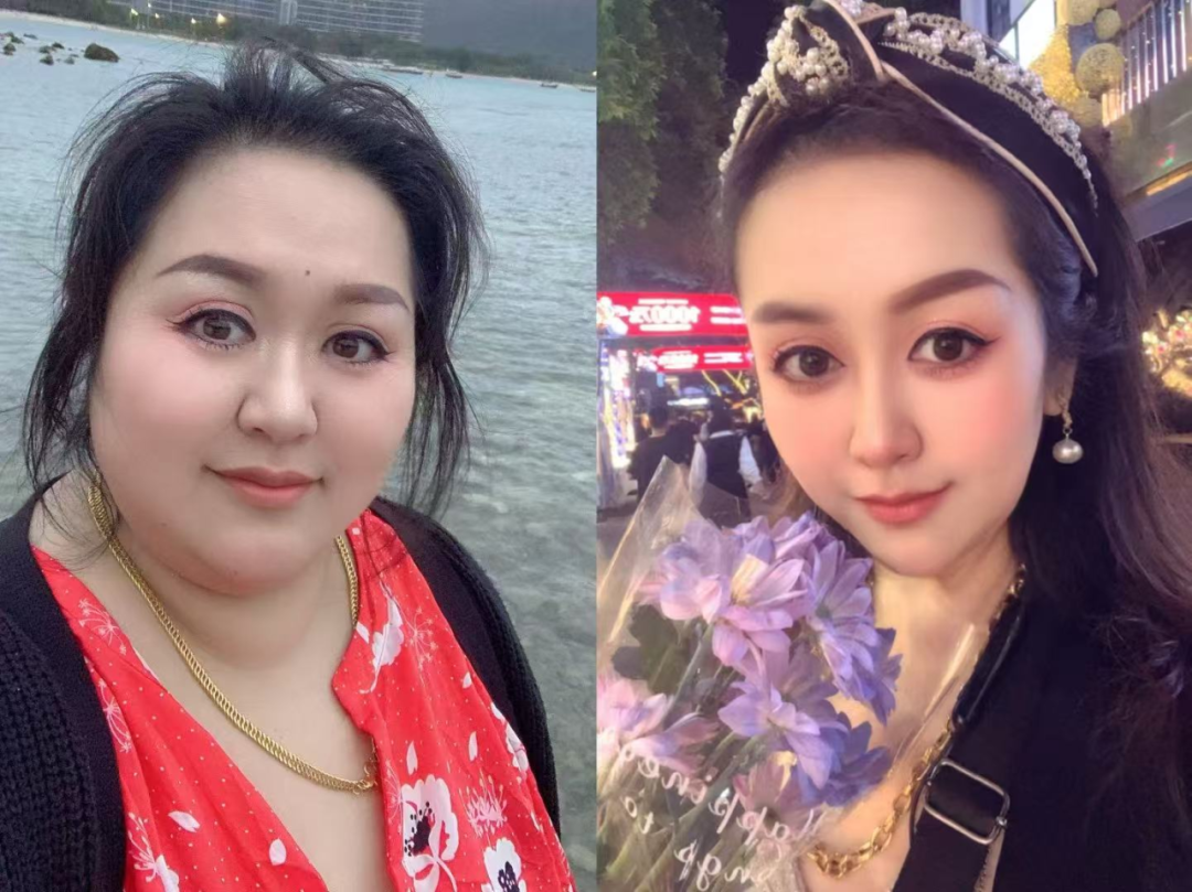 病例分享|烧烤店老板娘的逆袭:从224斤糖友到140斤女神 病例分享|烧烤店老板娘的逆袭:从224斤糖友到140斤女神